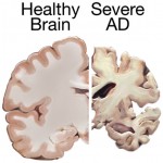 Alzheimer's brain