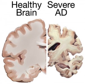 Alzheimer's brain