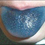 blue-stained-tongue-for-supertaster-test